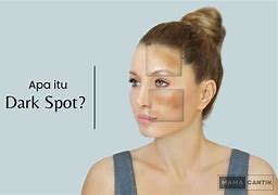 Apa Artinya Dark Spot